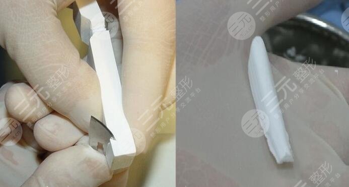 膨体隆鼻手术