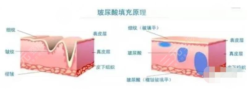 贝丽姿玻尿酸