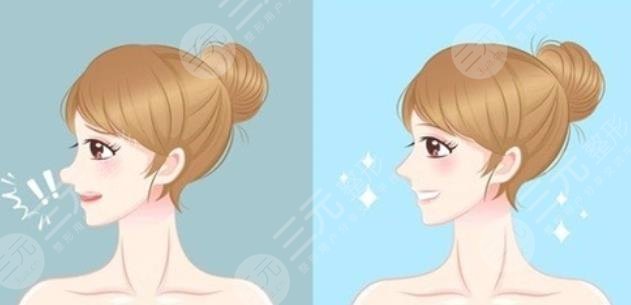 天津河东丽人整形价格表|隆鼻失败修复真人案例分享