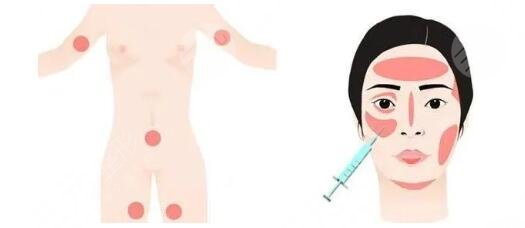 天津自体脂肪填充哪家医院好？脂肪填充价格详解