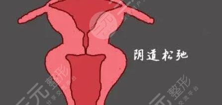 私密缩紧术