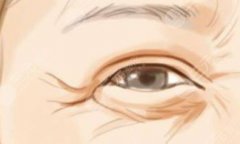 眼周小熨斗有果吗，是怎么做的，多少钱？超全眼部抗衰指南！