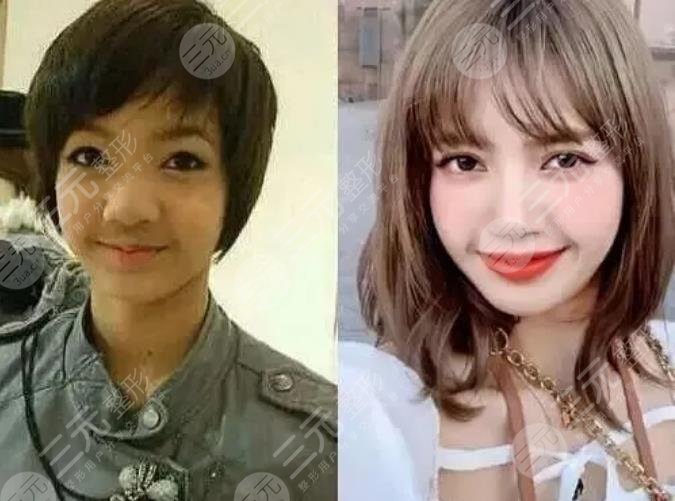 Lisa整容了吗?