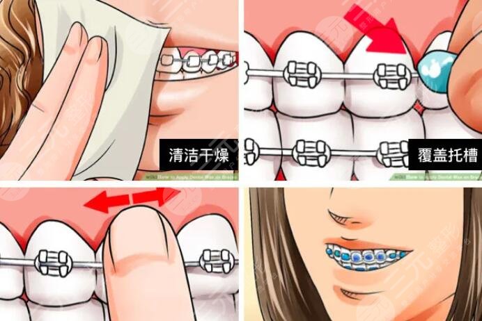 牙齿矫正的副作用都有哪些