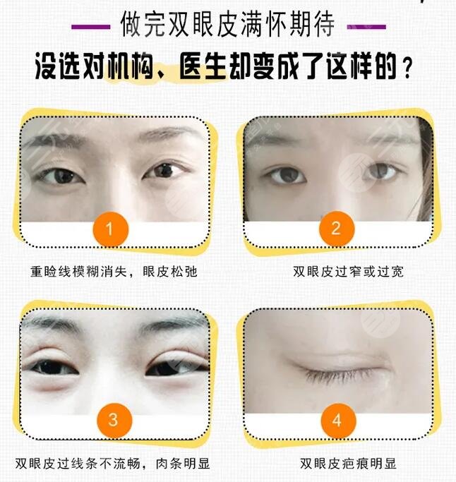 )眼部整形失败在半年之后才可以修复吗?