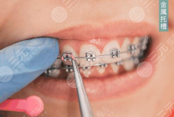 金属矫正牙齿需要多久时间