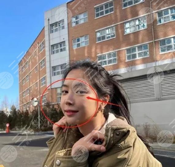 前Apink门面近照鼻子透光疑似整容失败?