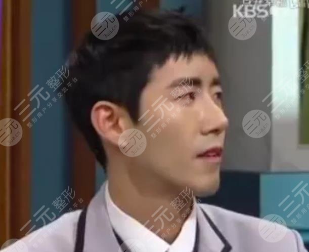 黄光熙近照“换头”成功整容失败修复实例!