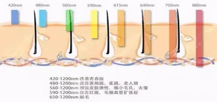 光子嫩肤的原理是怎样的?