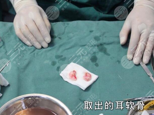耳软骨隆鼻整形手术的成好吗