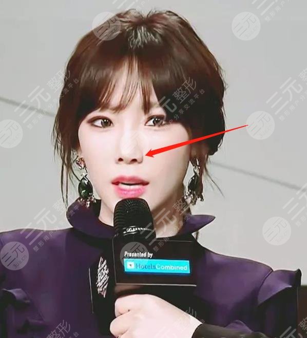 金泰妍有没有整容多次整容现在脸崩了鼻孔一大一小疑似隆鼻失败