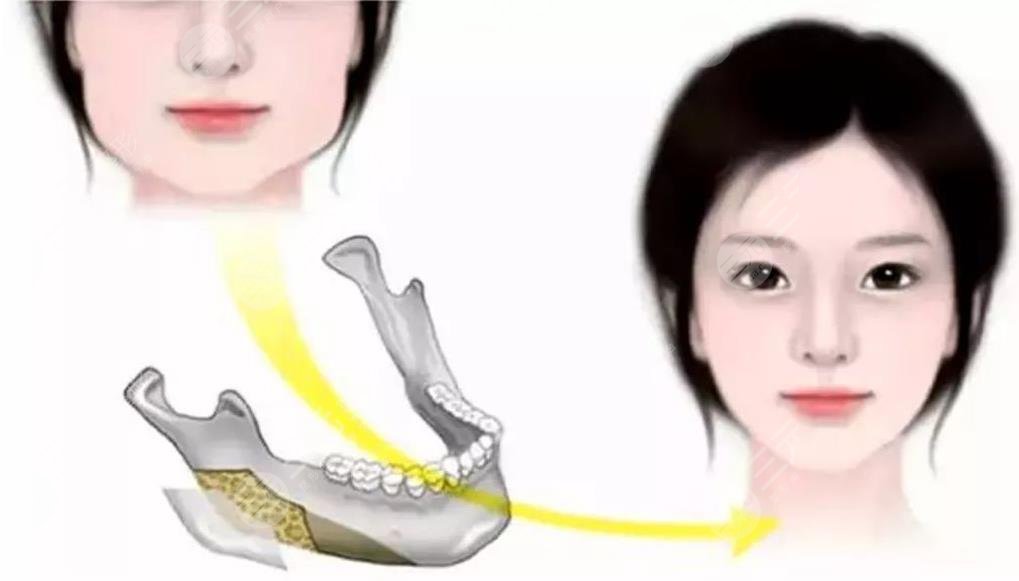 万家燕鸿源王珍祥医生下颌角切除过程和术后照片强势分享！