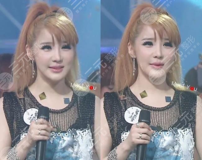 朴春变脸成“怪物”?她动了哪些地方?