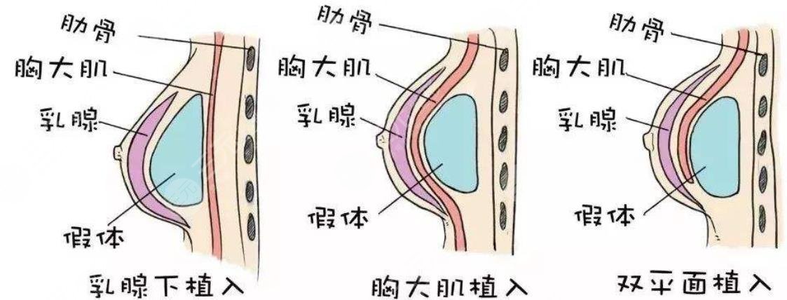 假体隆胸会有出血量吗