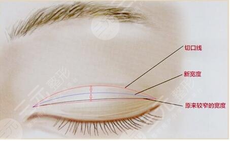 双眼皮失败修复的概述