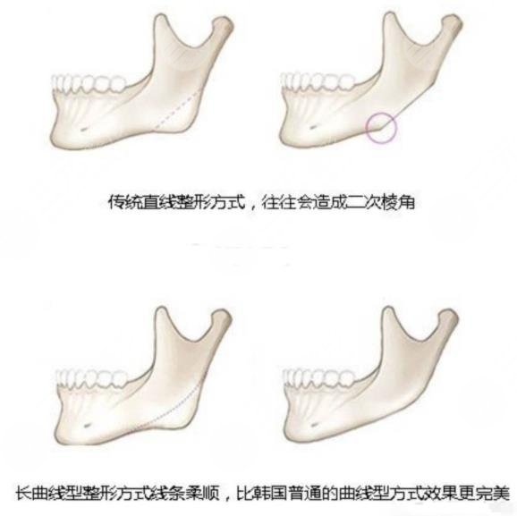 下颌角整形