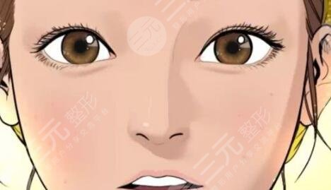 双眼皮修复手术 **双眼皮又回来了