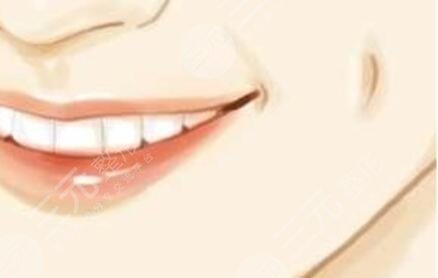 酒窝,再造术,前后,对比,果,图片