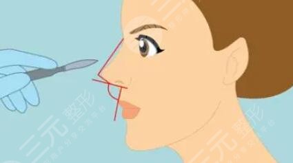 芭比眼韩式翘鼻