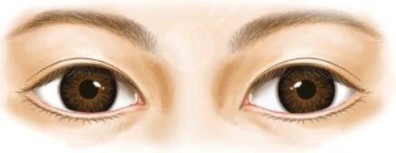 芭比眼开内外眼角手术前后效果对比照片和恢复经历分享