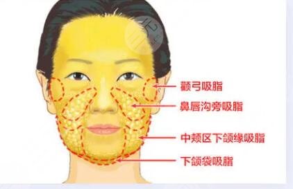 婴儿肥做了面部吸脂 面部吸脂果图奉上