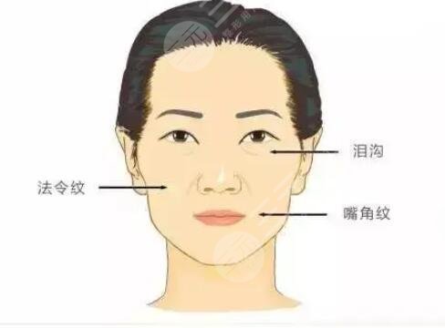 自体脂肪面部填充,年轻才是真的美~~~