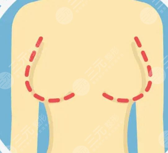 乳头缩小术，挽回老公的心