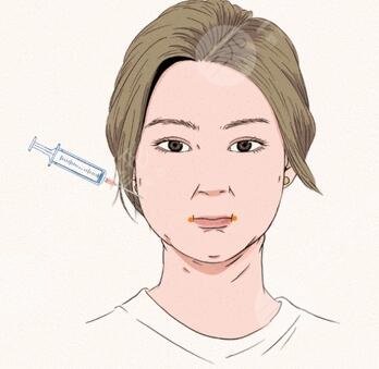 看看我的面部吸脂果图 专属于我的小V脸