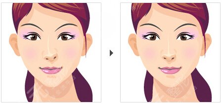 非手术隆鼻+鼻尖肥大整形 御姐范十足