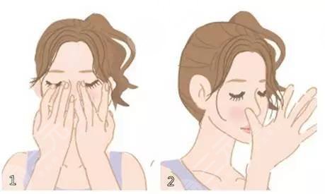 非手术隆鼻+鼻尖肥大整形 御姐范十足