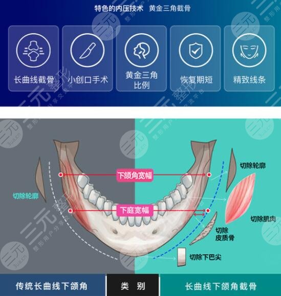 武汉中翰 吴中兴磨骨技术