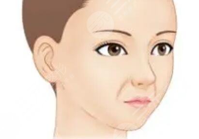面部轮廓整形+自体脂肪填充额头 术后恢复得很自然
