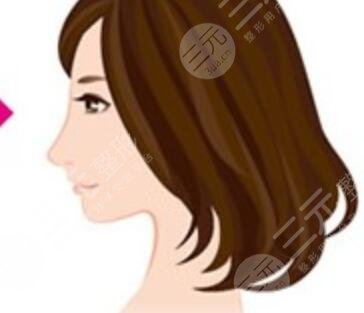 颧骨缩小术+自体脂肪填充额头 有人说像韩国明星