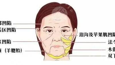 假体丰额头,硅胶假体隆鼻