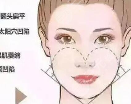 详细部自体脂肪填充+鼻翼缩小整形 变美