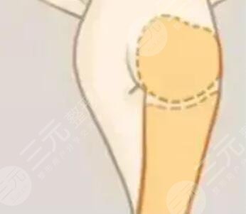 臀部吸脂手术,很无.敌变身美