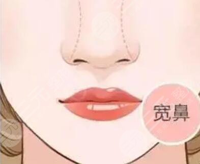 青州市人民医院做的膨体假体隆鼻+双眼皮