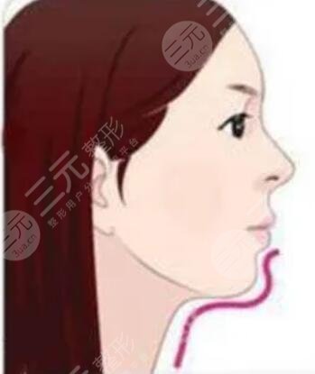 下巴短,注射玻尿酸丰下巴