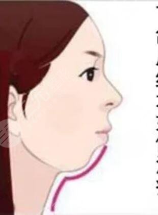 广州曙光医学美容医院,假体垫下巴