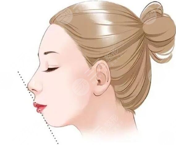 广州曙光医学美容医院,假体垫下巴