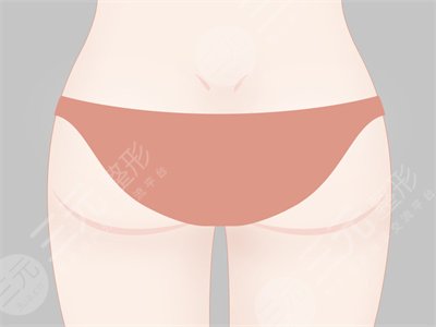 大腿部吸脂减肥果前后对比图 大腿部吸脂手术恢复全过程
