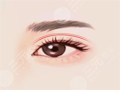 切开法双眼皮开内眼角硅胶隆鼻整形 丑小鸭变天鹅