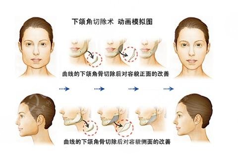 下颌角切除手术真实案例 下颌角切除术后变美过程分享