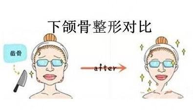 下颌角切除手术真实案例 下颌角切除术后变美过程分享