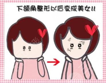 下颌角切除手术真实案例 下颌角切除术后变美过程分享