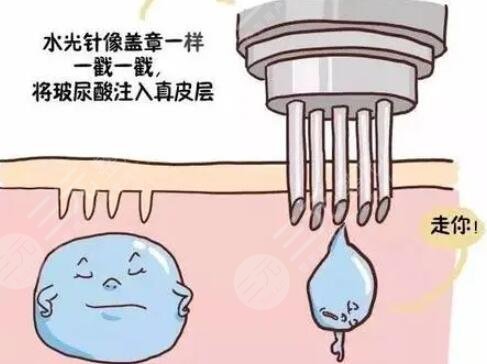 注射了水光补水皮肤变好了 水光补水注射后注意事项