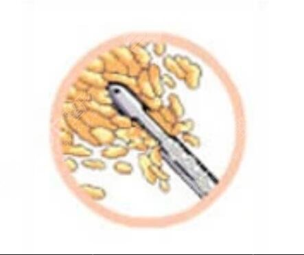 北京叶美人除眼袋手术+脂肪面部填充真实案例对比图分享