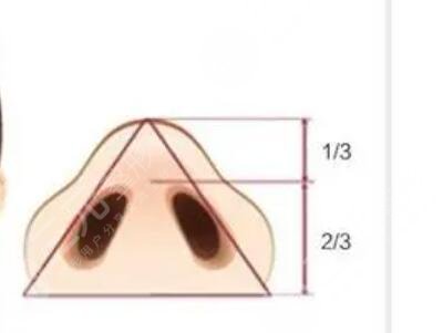 深圳科美丽格隆鼻整形+垫下巴真实案例前后果对比分享