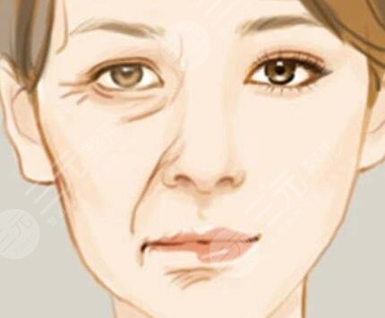 内切去眼袋+详细部自体脂肪填充真实案例果对比图