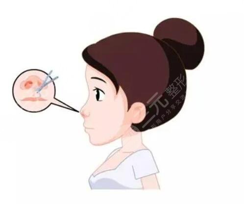 假体隆鼻+耳软骨垫鼻尖果对比图，亲身经历分享